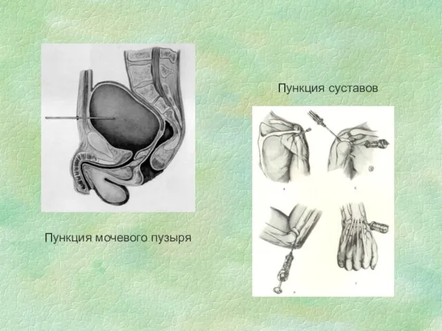 Пункция мочевого пузыря Пункция суставов