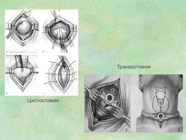 Трахеостомия Цистостомия