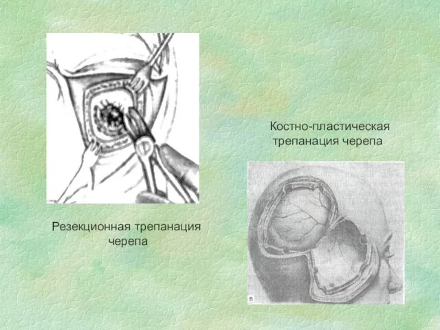 Резекционная трепанация черепа Костно-пластическая трепанация черепа