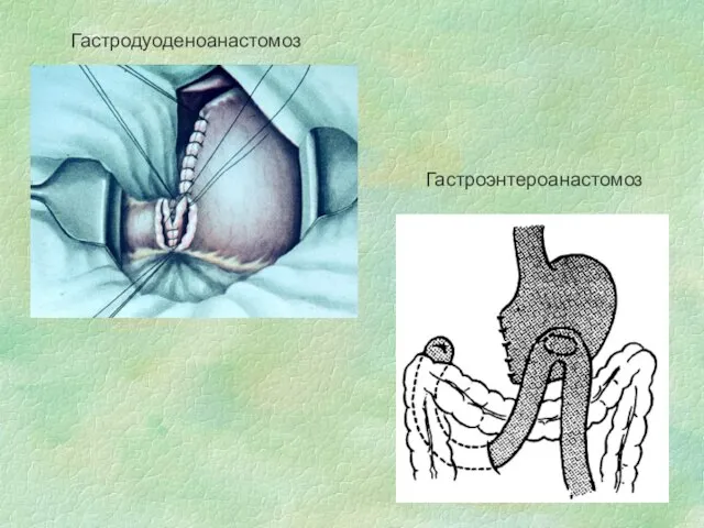 Гастродуоденоанастомоз Гастроэнтероанастомоз