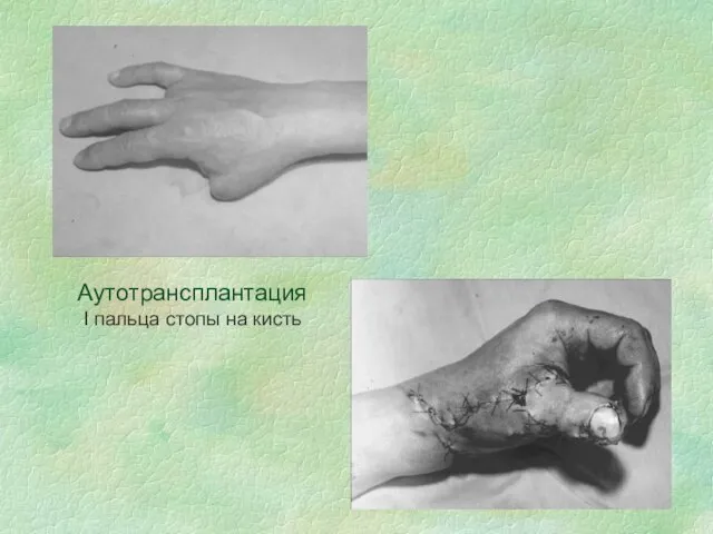Аутотрансплантация I пальца стопы на кисть