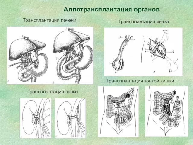 Трансплантация почки Трансплантация печени Трансплантация яичка Трансплантация тонкой кишки Аллотрансплантация органов