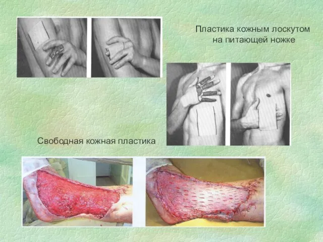 Пластика кожным лоскутом на питающей ножке Свободная кожная пластика