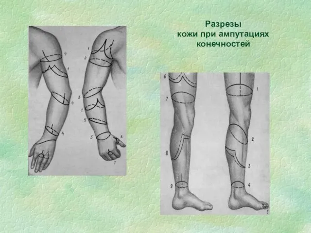 Разрезы кожи при ампутациях конечностей