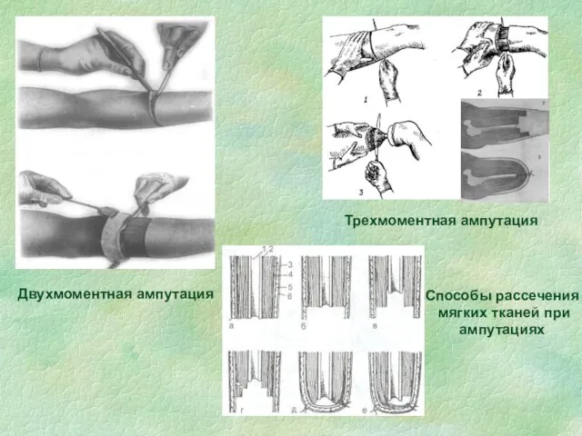 Двухмоментная ампутация Трехмоментная ампутация Способы рассечения мягких тканей при ампутациях