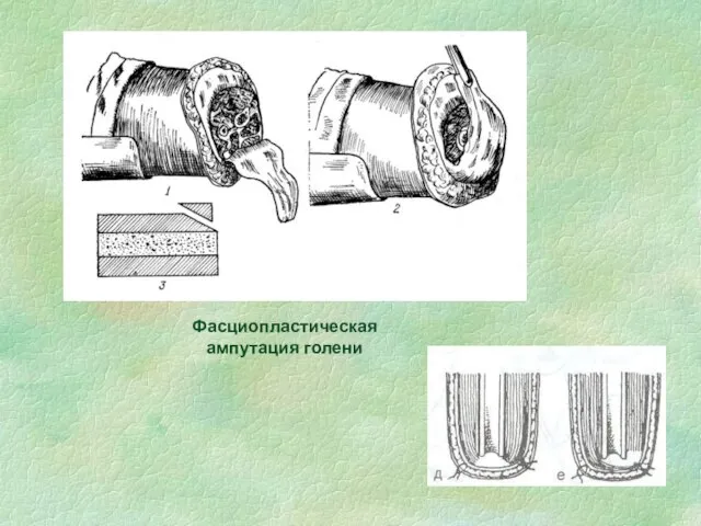 Фасциопластическая ампутация голени