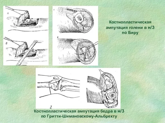 Костнопластическая ампутация голени в н/3 по Биру Костнопластическая ампутация бедра в н/3 по Гритти-Шимановскому-Альбрехту