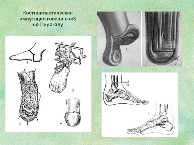 Костнопластическая ампутация голени в н/3 по Пирогову