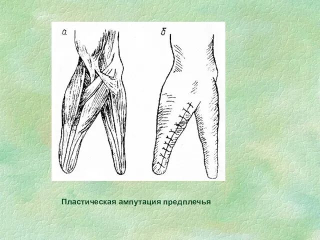 Пластическая ампутация предплечья