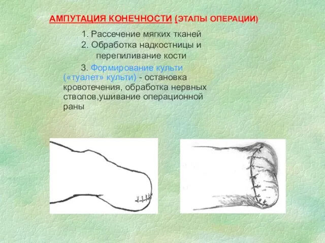 1. Рассечение мягких тканей 2. Обработка надкостницы и перепиливание кости 3.