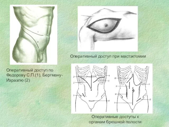 Оперативный доступ по Федорову С.П.(1), Бергману- Израэлю (2) Оперативные доступы к