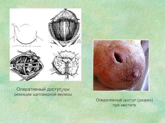 Оперативный доступ при резекции щитовидной железы Оперативный доступ (разрез) при мастите
