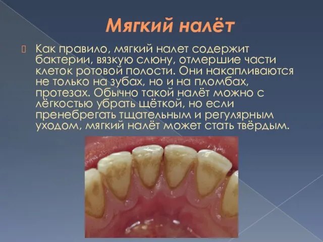 Мягкий налёт Как правило, мягкий налет содержит бактерии, вязкую слюну, отмершие