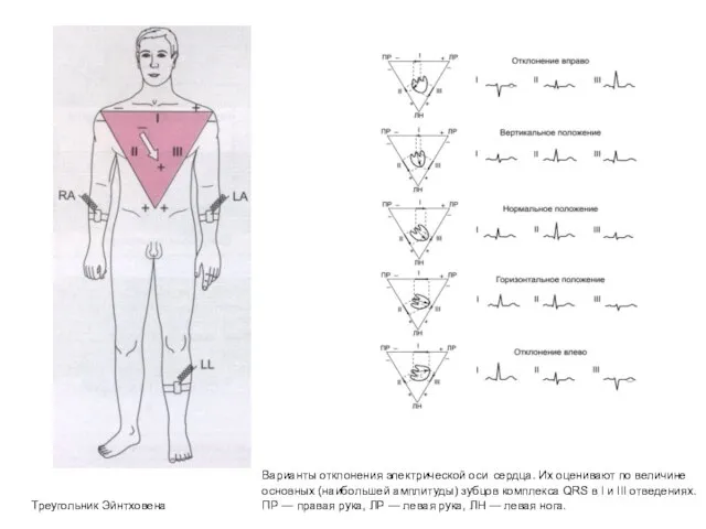 Треугольник Эйнтховена Варианты отклонения электрической оси сердца. Их оценивают по величине