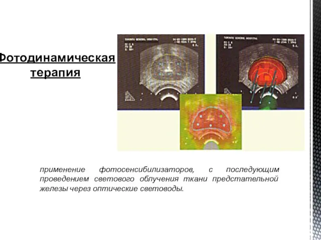 Фотодинамическая терапия применение фотосенсибилизаторов, с последующим проведением светового облучения ткани предстательной железы через оптические световоды.