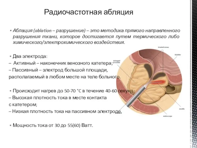 Аблация (ablation – разрушение) – это методика прямого направленного разрушения ткани,