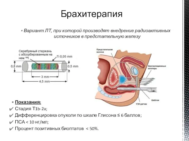 Вариант ЛТ, при которой производят внедрение радиоактивных источников в предстательную железу