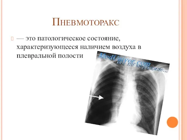 Пневмоторакс — это патологическое состояние, характеризующееся наличием воздуха в плевральной полости