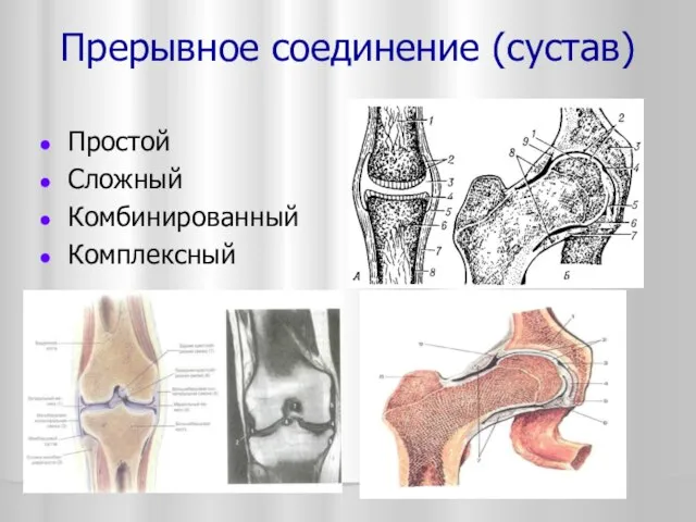 Прерывное соединение (сустав) Простой Сложный Комбинированный Комплексный