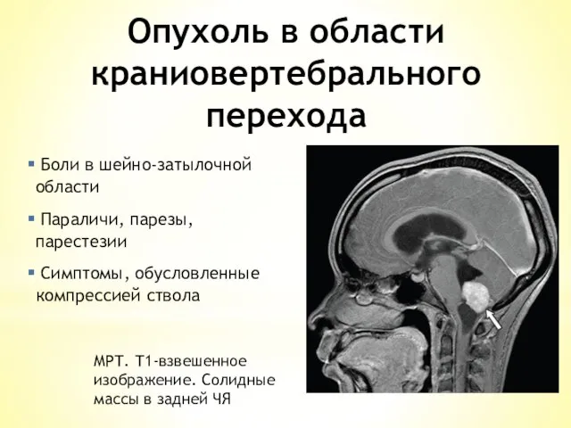 Опухоль в области краниовертебрального перехода Боли в шейно-затылочной области Параличи, парезы,