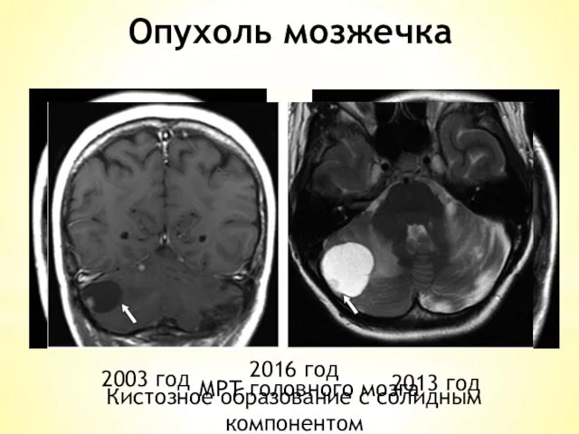 Опухоль мозжечка МРТ головного мозга 2003 год 2013 год 2016 год Кистозное образование с солидным компонентом