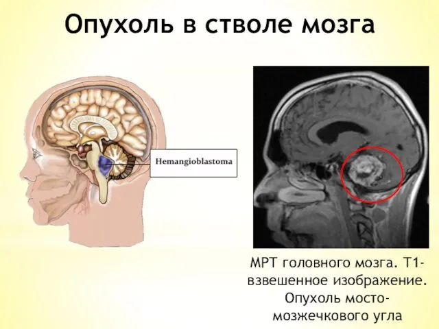 МРТ головного мозга. Т1-взвешенное изображение. Опухоль мосто-мозжечкового угла Опухоль в стволе мозга