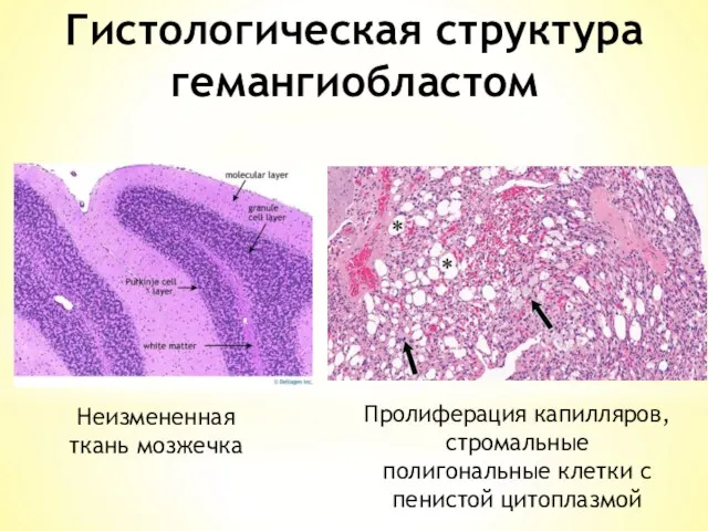 Гистологическая структура гемангиобластом Неизмененная ткань мозжечка Пролиферация капилляров, стромальные полигональные клетки с пенистой цитоплазмой