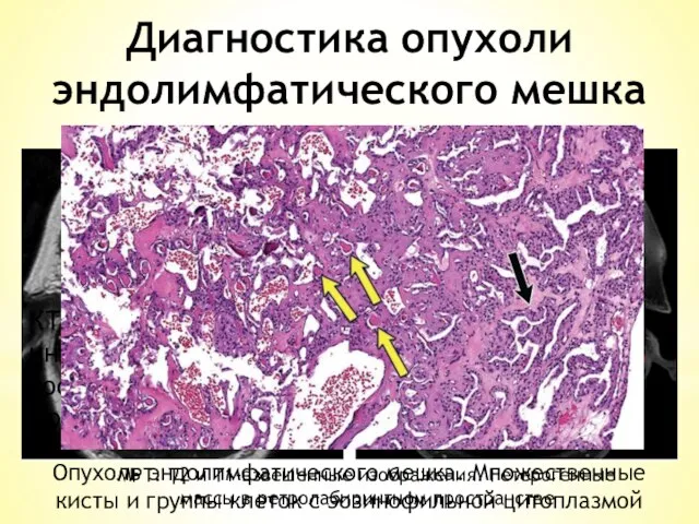 КТ МРТ Диагностика опухоли эндолимфатического мешка КТ. Массивная инфильтрация. Картина кости,