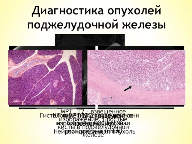 Диагностика опухолей поджелудочной железы МРТ. Т2 – взвешенное изображение. Простые кисты