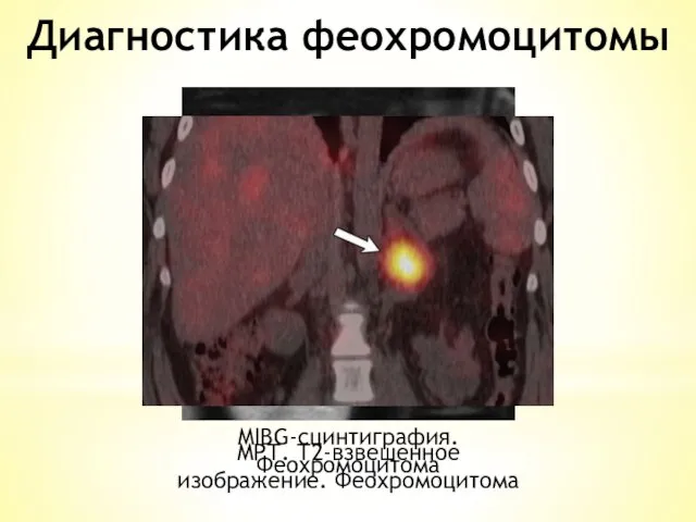 Диагностика феохромоцитомы МРТ. Т2-взвешенное изображение. Феохромоцитома MIBG-сцинтиграфия. Феохромоцитома