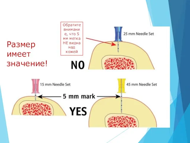 Обратите внимание, что 5 мм метка НЕ видна над кожей Размер имеет значение!