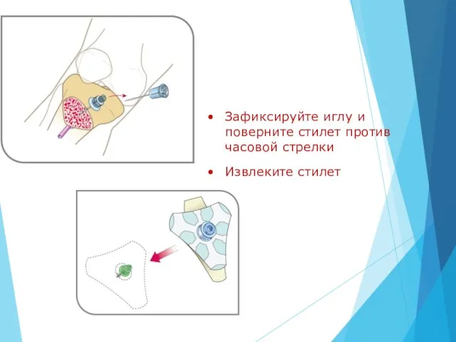 Зафиксируйте иглу и поверните стилет против часовой стрелки Извлеките стилет