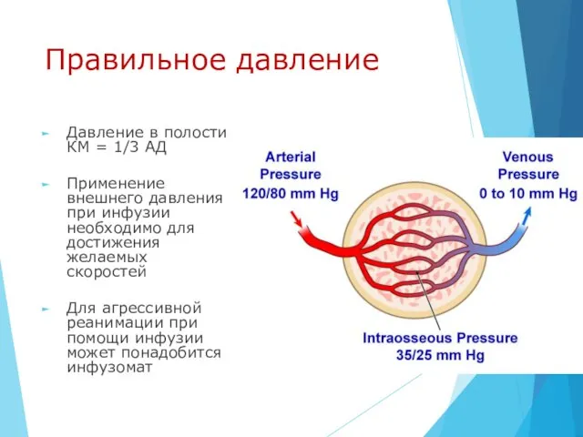 Правильное давление Давление в полости КМ = 1/3 АД Применение внешнего