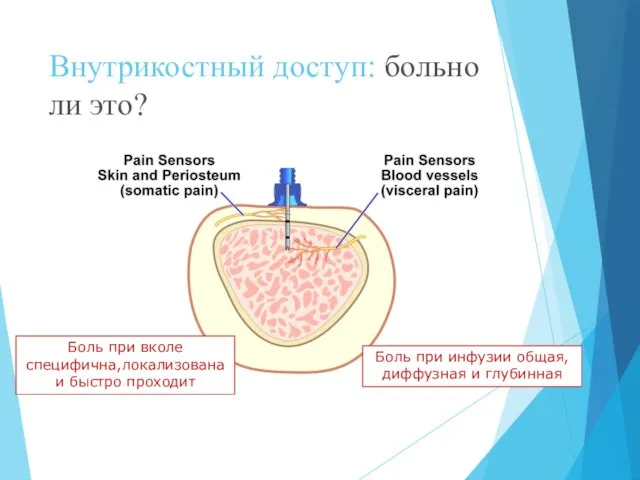 Внутрикостный доступ: больно ли это? Боль при вколе специфична,локализована и быстро