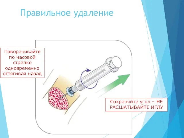 Правильное удаление Поворачивайте по часовой стрелке одновременно оттягивая назад Сохраняйте угол – НЕ РАСШАТЫВАЙТЕ ИГЛУ