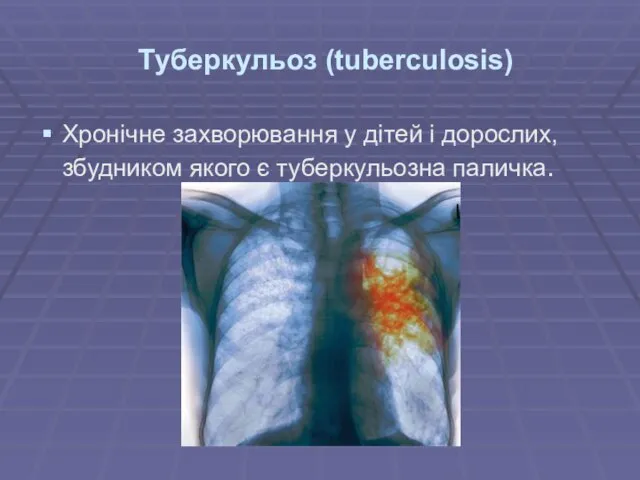 Туберкульоз (tuberculosis) Хронічне захворювання у дітей і дорослих, збудником якого є туберкульозна паличка.