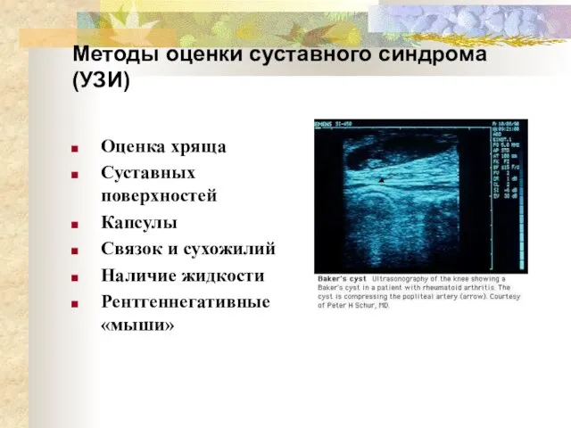 Методы оценки суставного синдрома (УЗИ) Оценка хряща Суставных поверхностей Капсулы Связок