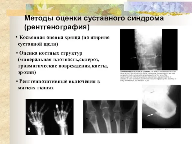 Методы оценки суставного синдрома (рентгенография) Косвенная оценка хряща (по ширине суставной