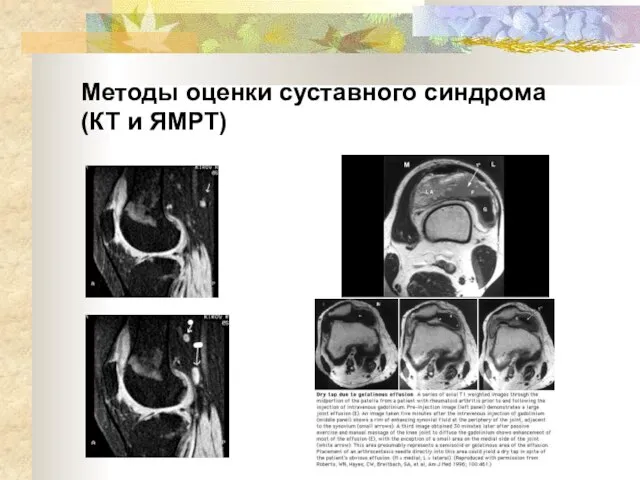 Методы оценки суставного синдрома (КТ и ЯМРТ)