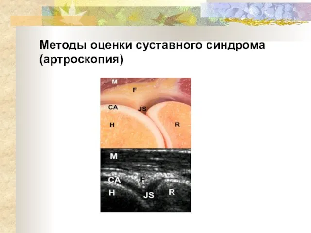 Методы оценки суставного синдрома (артроскопия)