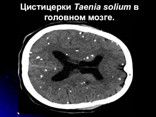 Цистицерки Taenia solium в головном мозге.