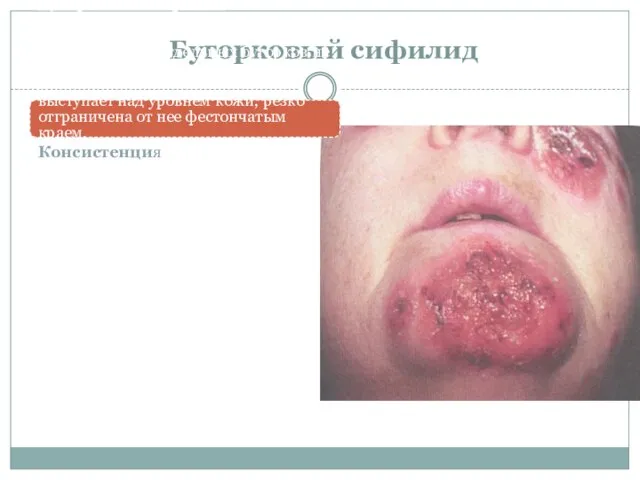 Бугорковый сифилид Бугорковый сифилид «площадкой» (syphilis tuberculosa en nappe, seu diffusa)