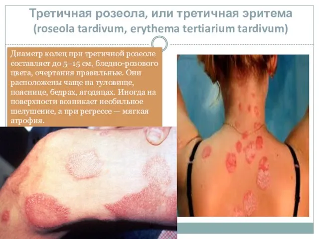 Третичная розеола, или третичная эритема (roseola tardivum, erythema tertiarium tardivum) Диаметр