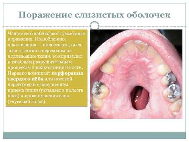 Поражение слизистых оболочек Чаще всего наблюдают гуммозные поражения. Излюбленная локализация —