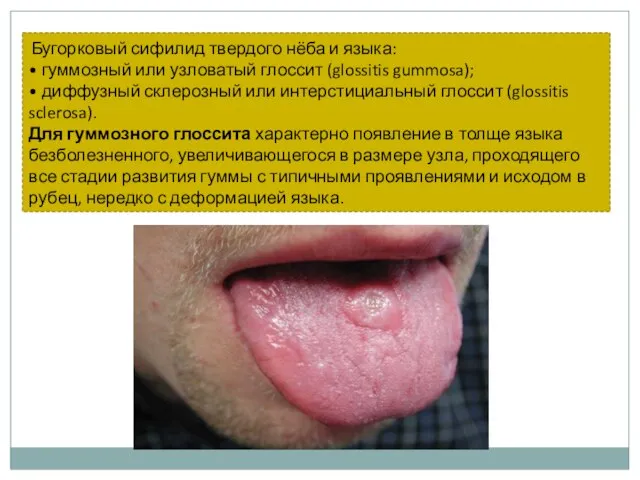 Бугорковый сифилид твердого нёба и языка: • гуммозный или узловатый глоссит