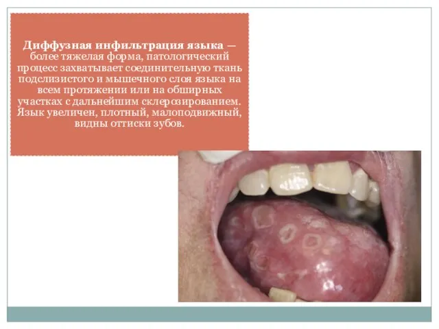 Диффузная инфильтрация языка — более тяжелая форма, патологический процесс захватывает соединительную