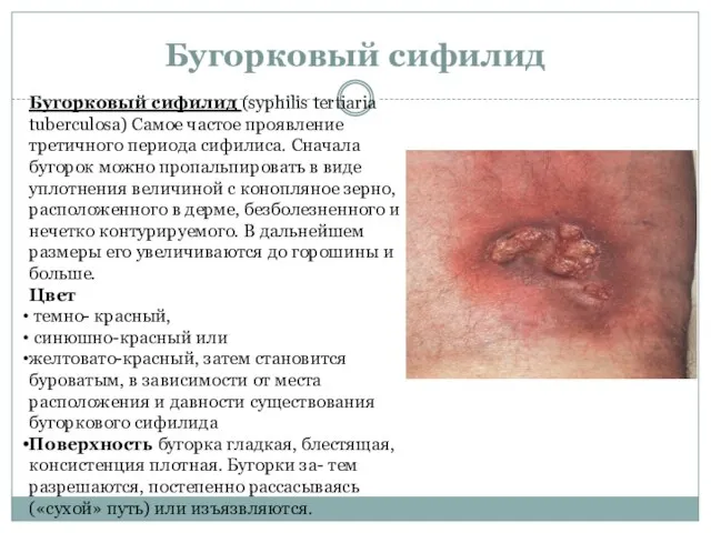 Бугорковый сифилид Бугорковый сифилид (syphilis tertiaria tuberculosa) Самое частое проявление третичного