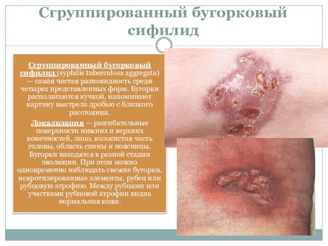 Сгруппированный бугорковый сифилид Сгруппированный бугорковый сифилид (syphilis tuberculosa aggregata) — самая