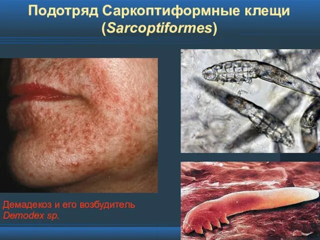 Подотряд Саркоптиформные клещи (Sarcoptiformes) Демадекоз и его возбудитель Demodex sp.