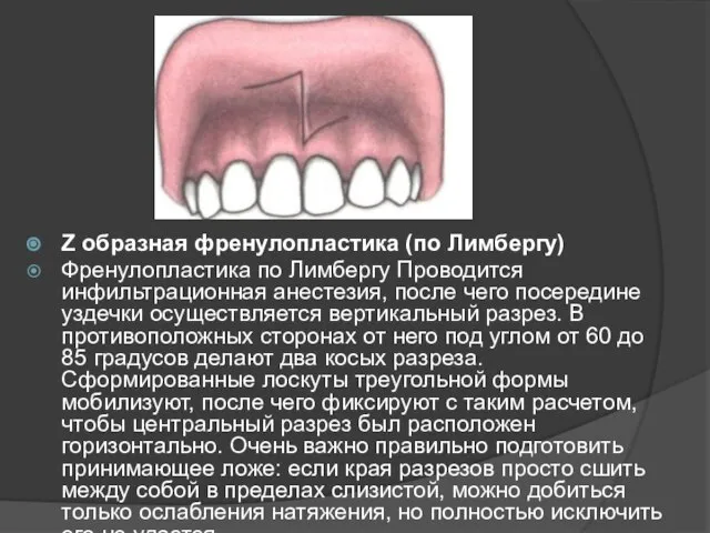 Z образная френулопластика (по Лимбергу) Френулопластика по Лимбергу Проводится инфильтрационная анестезия,